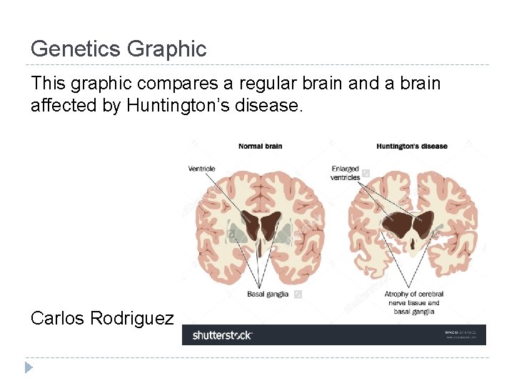 Genetics Graphic This graphic compares a regular brain and a brain affected by Huntington’s