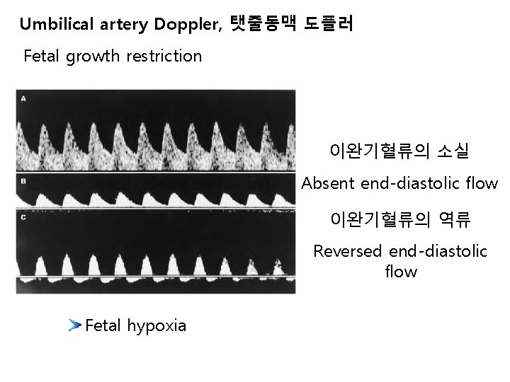 Umbilical artery Doppler, 탯줄동맥 도플러 Fetal growth restriction 이완기혈류의 소실 Absent end-diastolic flow 이완기혈류의