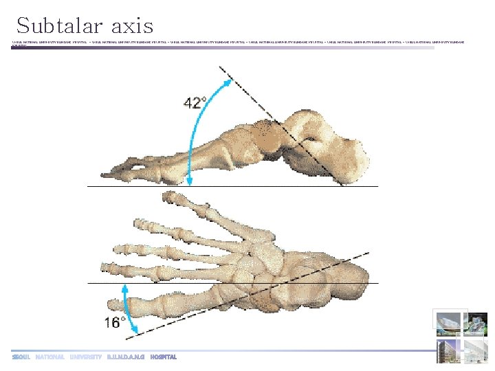 Subtalar axis SEOUL NATIONAL UNIVERSITY BUNDANG HOSPITAL ◦ SEOUL NATIONAL UNIVERSITY BUNDANG HOSPITAL ◦