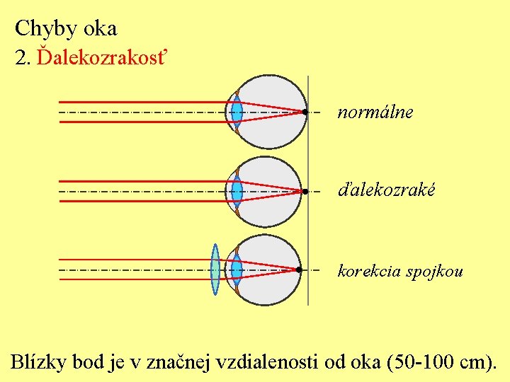 Chyby oka 2. Ďalekozrakosť normálne ďalekozraké korekcia spojkou Blízky bod je v značnej vzdialenosti