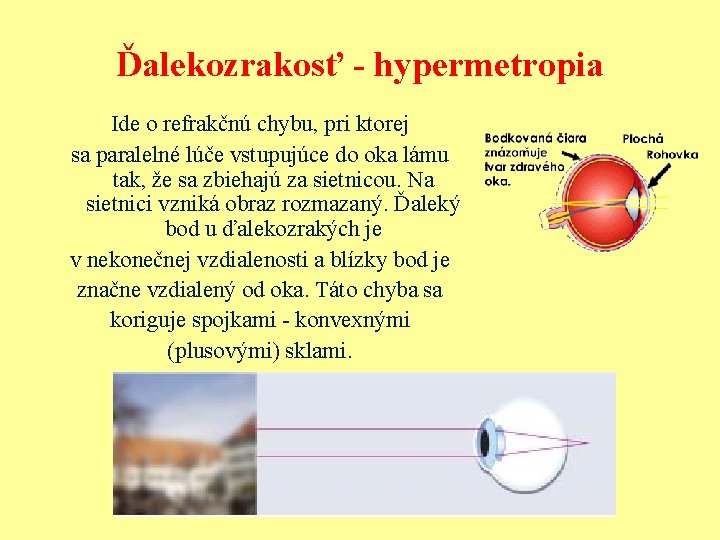 Ďalekozrakosť - hypermetropia Ide o refrakčnú chybu, pri ktorej sa paralelné lúče vstupujúce do