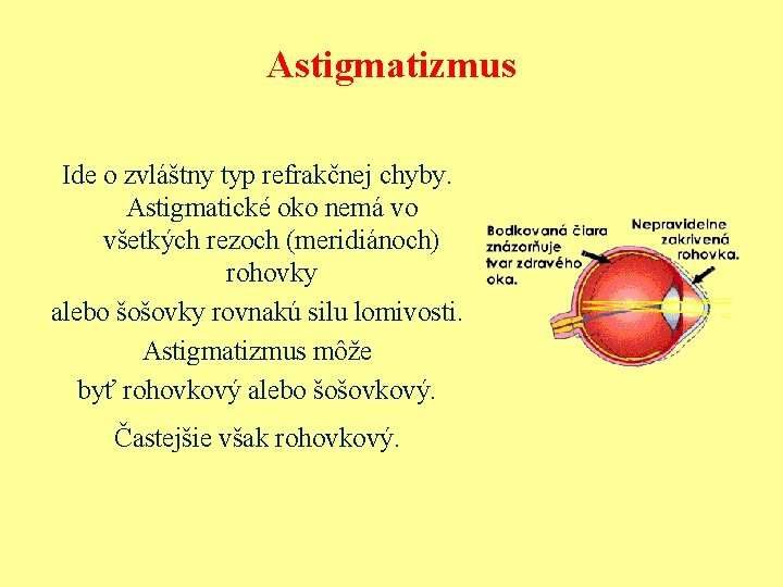 Astigmatizmus Ide o zvláštny typ refrakčnej chyby. Astigmatické oko nemá vo všetkých rezoch (meridiánoch)