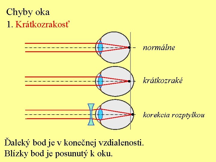 Chyby oka 1. Krátkozrakosť normálne krátkozraké korekcia rozptylkou Ďaleký bod je v konečnej vzdialenosti.