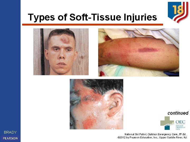 Types of Soft-Tissue Injuries continued BRADY National Ski Patrol, Outdoor Emergency Care, 5 th
