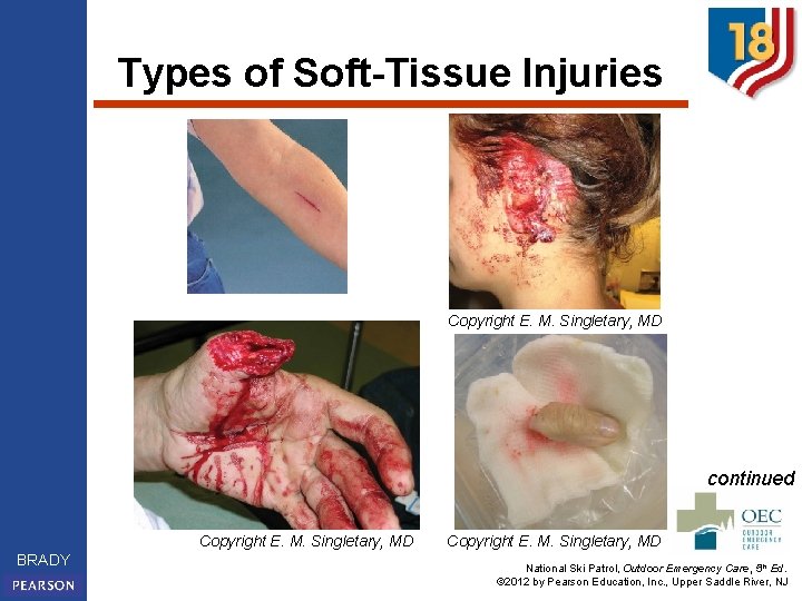 Types of Soft-Tissue Injuries Copyright E. M. Singletary, MD continued Copyright E. M. Singletary,