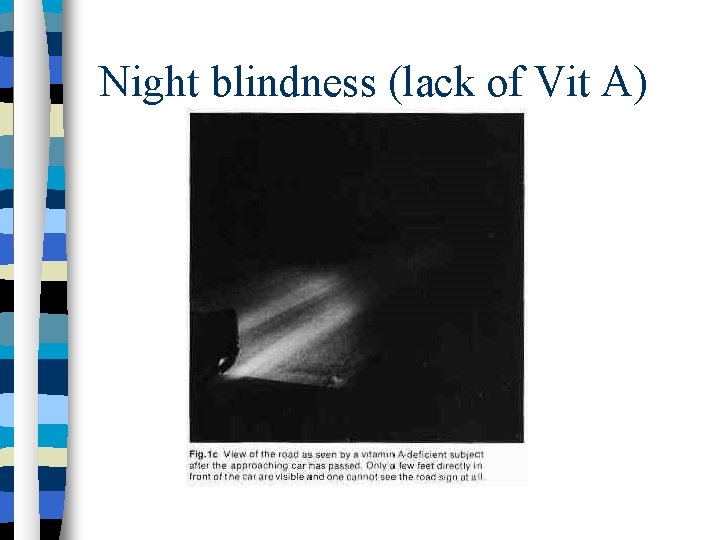 Night blindness (lack of Vit A) 