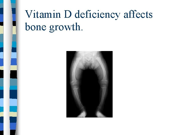 Vitamin D deficiency affects bone growth. 