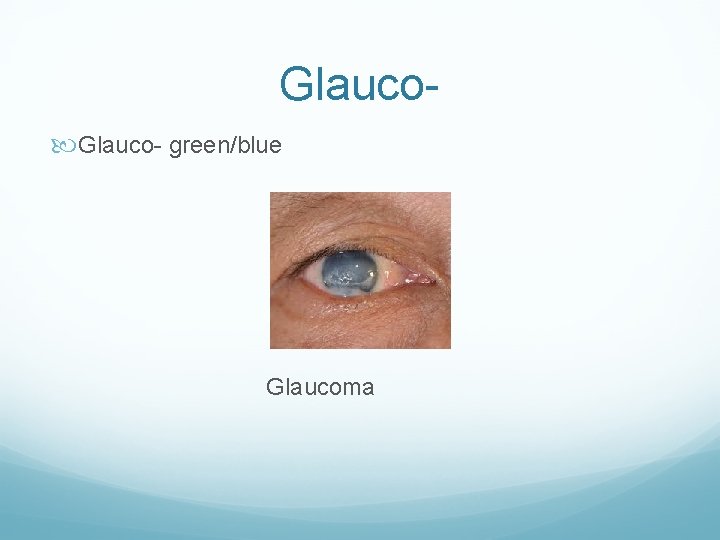 Glauco- green/blue Glaucoma 