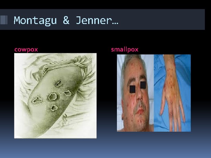 Montagu & Jenner… cowpox smallpox 