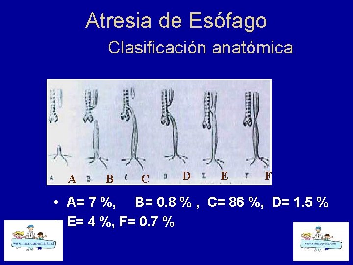 Atresia de Esófago Clasificación anatómica A B C D E F • A= 7