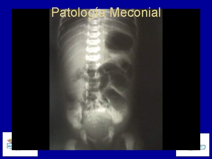 Patología Meconial 