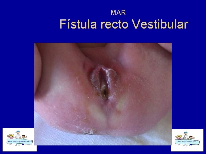 MAR Fístula recto Vestibular 