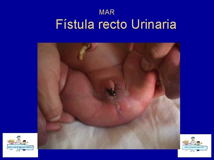 MAR Fístula recto Urinaria 