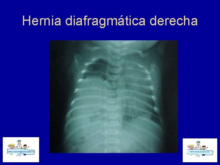 Hernia diafragmática derecha 