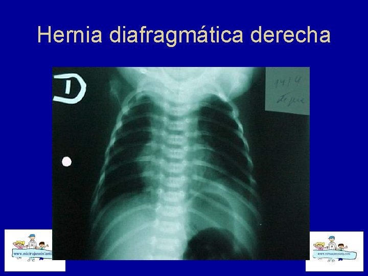 Hernia diafragmática derecha 