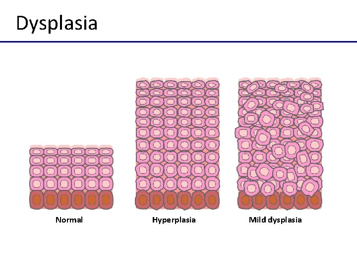 Dysplasia Normal Hyperplasia Mild dysplasia 