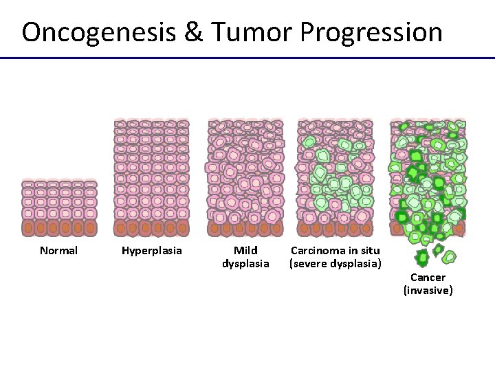 Oncogenesis & Tumor Progression Normal Hyperplasia Mild dysplasia Carcinoma in situ (severe dysplasia) Cancer
