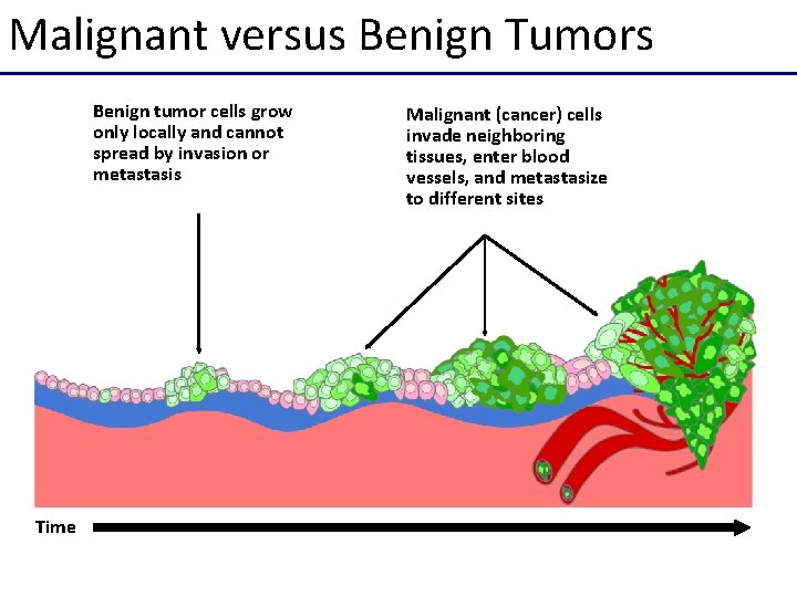 Malignant versus Benign Tumors Benign tumor cells grow only locally and cannot spread by