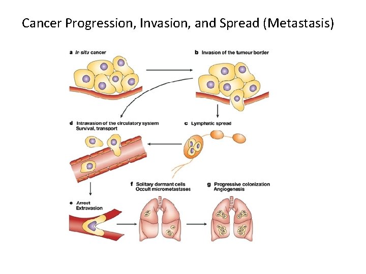 Cancer Progression, Invasion, and Spread (Metastasis) 