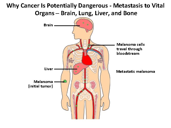 Why Cancer Is Potentially Dangerous - Metastasis to Vital Organs – Brain, Lung, Liver,