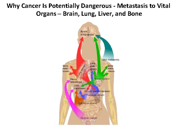 Why Cancer Is Potentially Dangerous - Metastasis to Vital Organs – Brain, Lung, Liver,