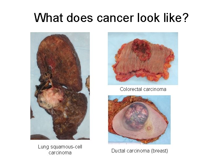 What does cancer look like? Colorectal carcinoma Lung squamous-cell carcinoma Ductal carcinoma (breast) 