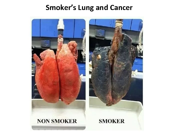 Smoker’s Lung and Cancer 