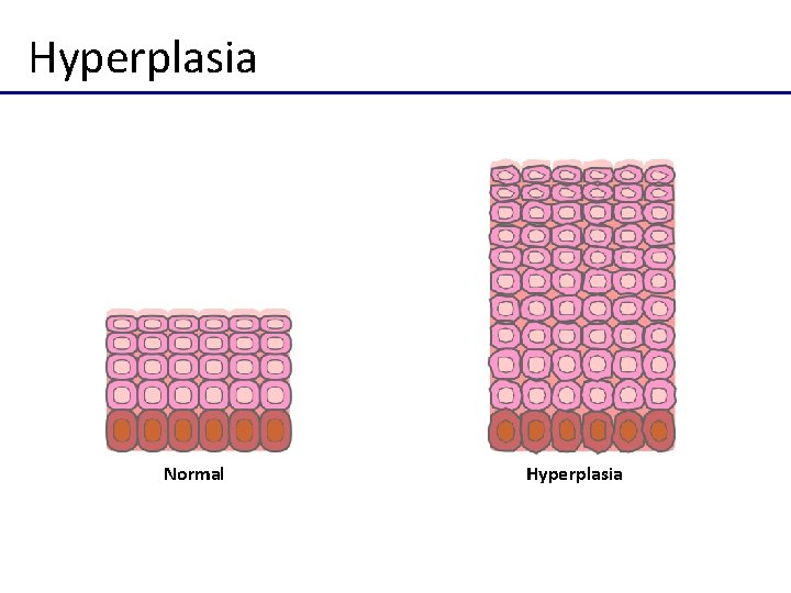 Hyperplasia Normal Hyperplasia 