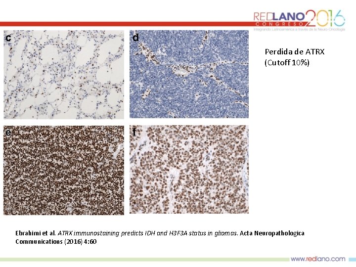 Perdida de ATRX (Cutoff 10%) Ebrahimi et al. ATRX immunostaining predicts IDH and H