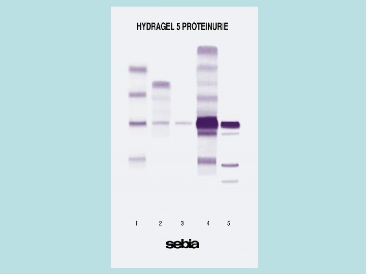 5 PROTEINURIE 
