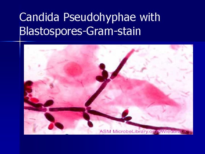 Candida Pseudohyphae with Blastospores-Gram-stain 