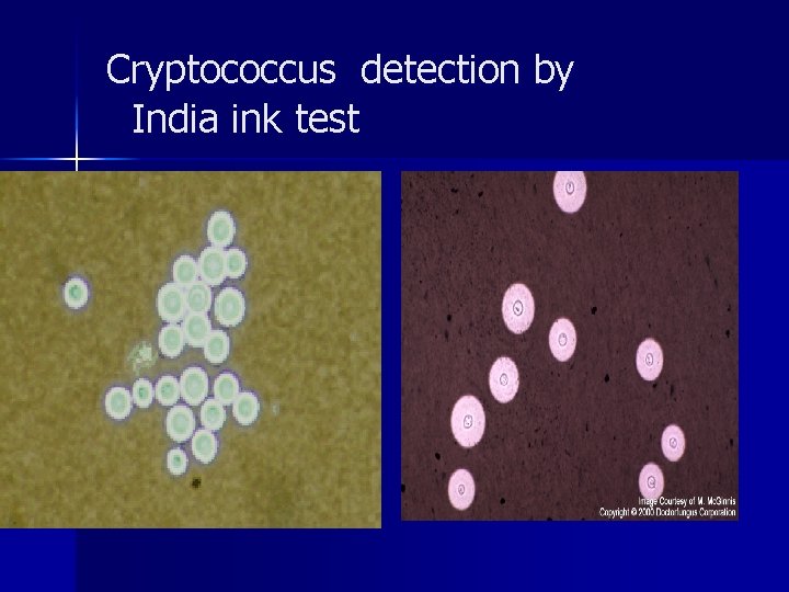 Cryptococcus detection by India ink test 
