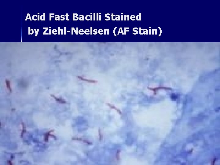 Acid Fast Bacilli Stained by Ziehl-Neelsen (AF Stain) 