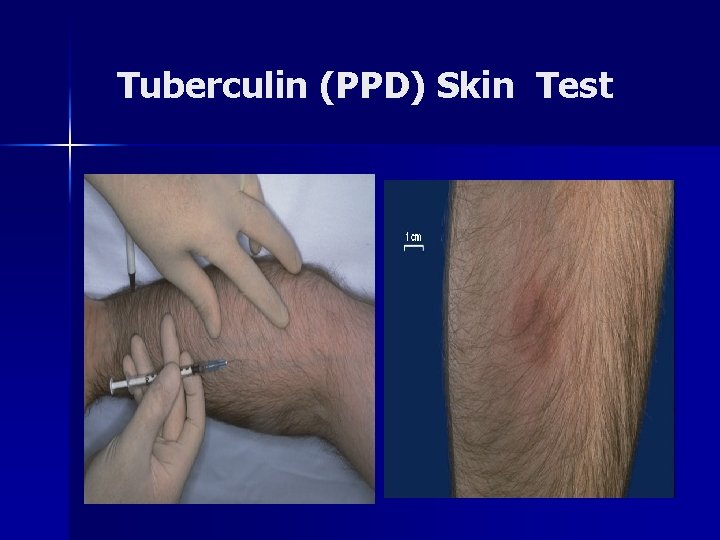 Tuberculin (PPD) Skin Test 