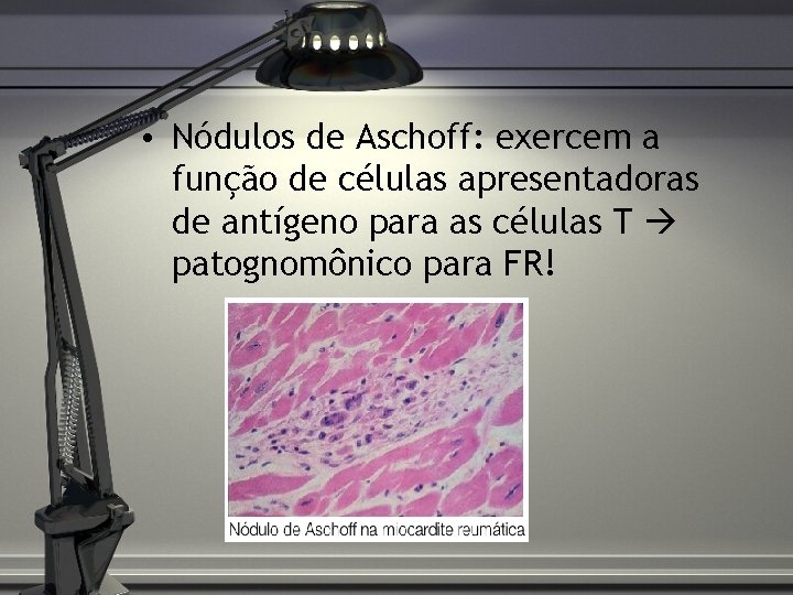  • Nódulos de Aschoff: exercem a função de células apresentadoras de antígeno para