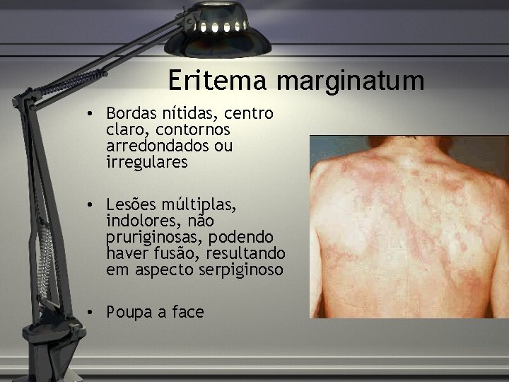 Eritema marginatum • Bordas nítidas, centro claro, contornos arredondados ou irregulares • Lesões múltiplas,