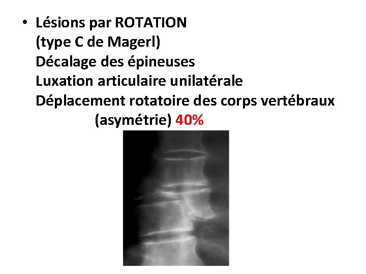  • Lésions par ROTATION (type C de Magerl) Décalage des épineuses Luxation articulaire