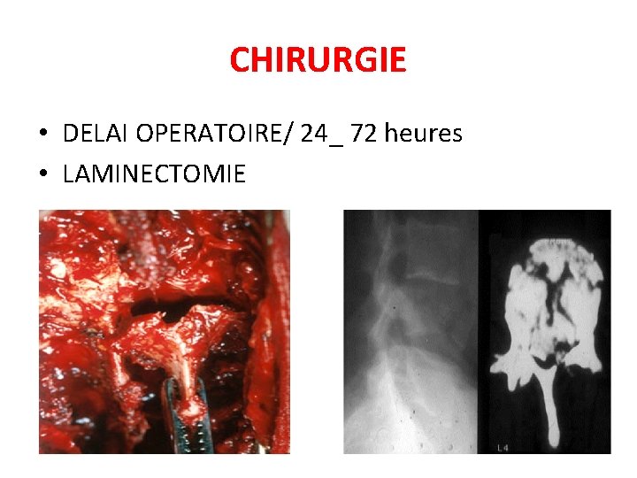 CHIRURGIE • DELAI OPERATOIRE/ 24_ 72 heures • LAMINECTOMIE 