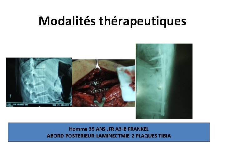 Modalités thérapeutiques Homme 35 ANS , FR A 3 -B FRANKEL ABORD POSTERIEUR-LAMINECTMIE-2 PLAQUES