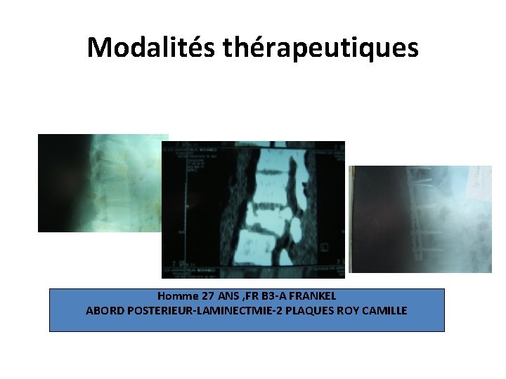 Modalités thérapeutiques Homme 27 ANS , FR B 3 -A FRANKEL ABORD POSTERIEUR-LAMINECTMIE-2 PLAQUES