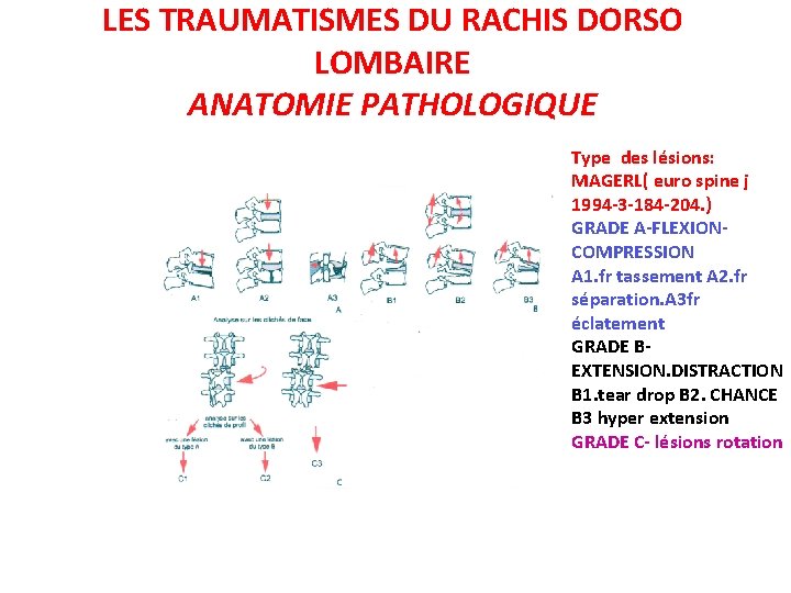 LES TRAUMATISMES DU RACHIS DORSO LOMBAIRE ANATOMIE PATHOLOGIQUE Type des lésions: MAGERL( euro spine