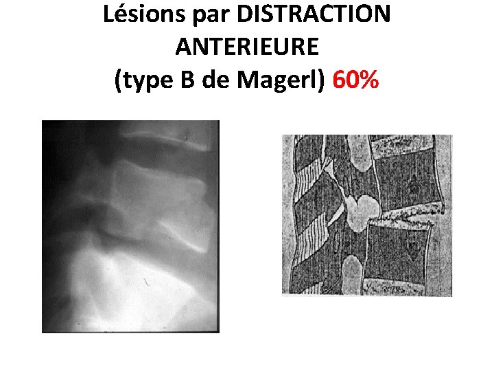 Lésions par DISTRACTION ANTERIEURE (type B de Magerl) 60% 