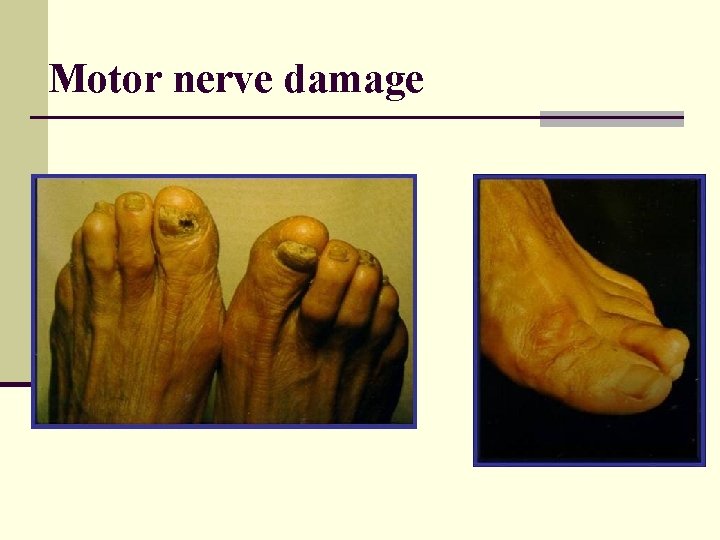 Motor nerve damage 