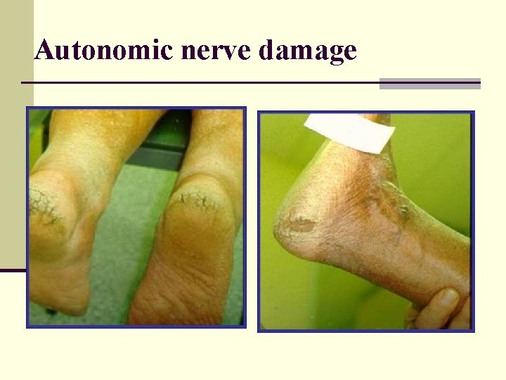 Autonomic nerve damage 