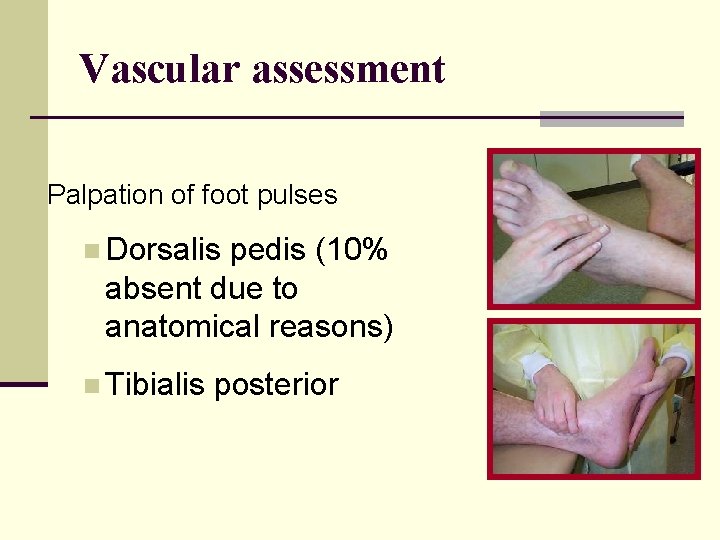 Vascular assessment Palpation of foot pulses n Dorsalis pedis (10% absent due to anatomical