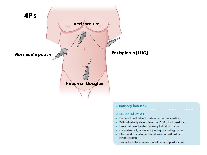 4 P s pericardium Perisplenic (LUQ) Morrison’s pouch Pouch of Douglas 