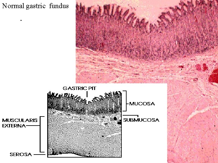 Normal gastric fundus. 