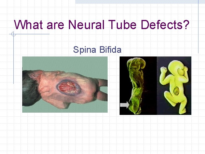 What are Neural Tube Defects? Spina Bifida 