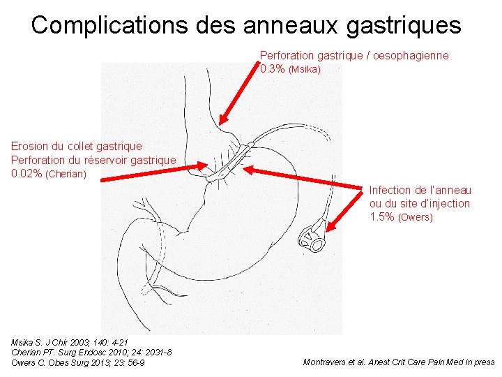 Complications des anneaux gastriques Perforation gastrique / oesophagienne 0. 3% (Msika) Erosion du collet