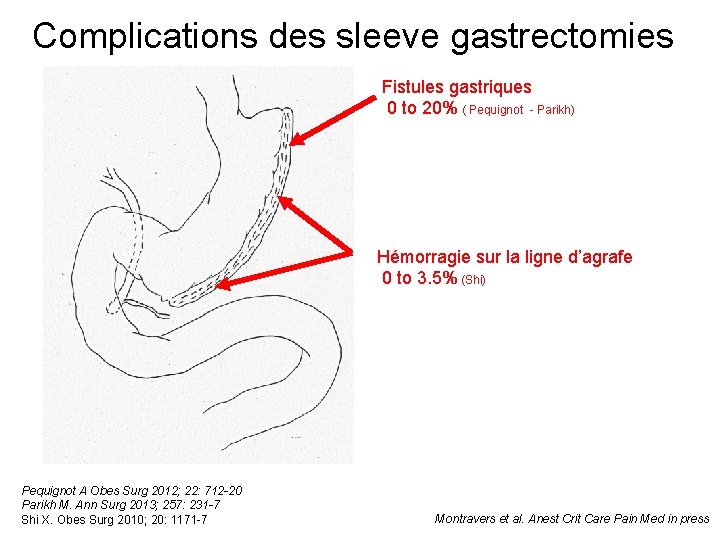 Complications des sleeve gastrectomies Fistules gastriques 0 to 20% ( Pequignot - Parikh) Hémorragie
